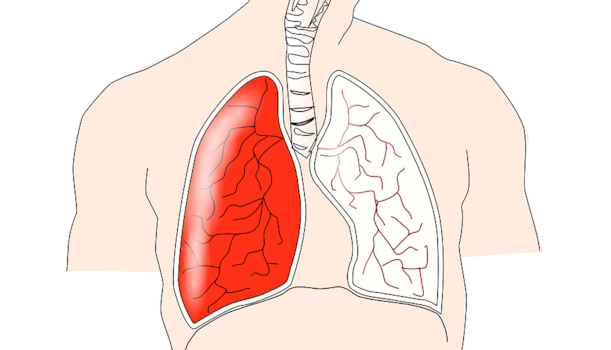 Patienteninformation Lungenembolie
